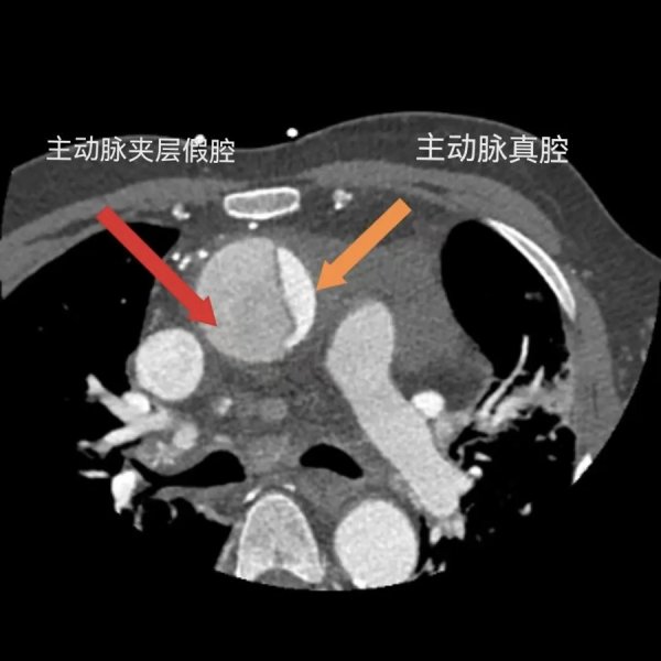 上海援疆专家抵喀第3天，救治高危A型主动脉夹层患者